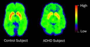 ADHD ADHD Causes