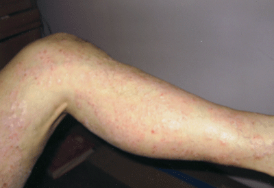 Natural Psoriasis Cure