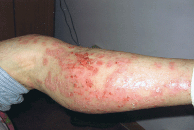 Organic Psoriasis Treamtent