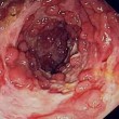 Crohns Crohn's Disease Natural Remedy