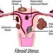 Uterine Fibroids Natural Cure to Uterine Fibroids