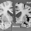 Natural Cures for Dementia