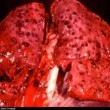 Lung Cancer Cures
